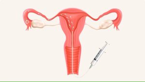 تزریق اسپرم به رحم در IUI